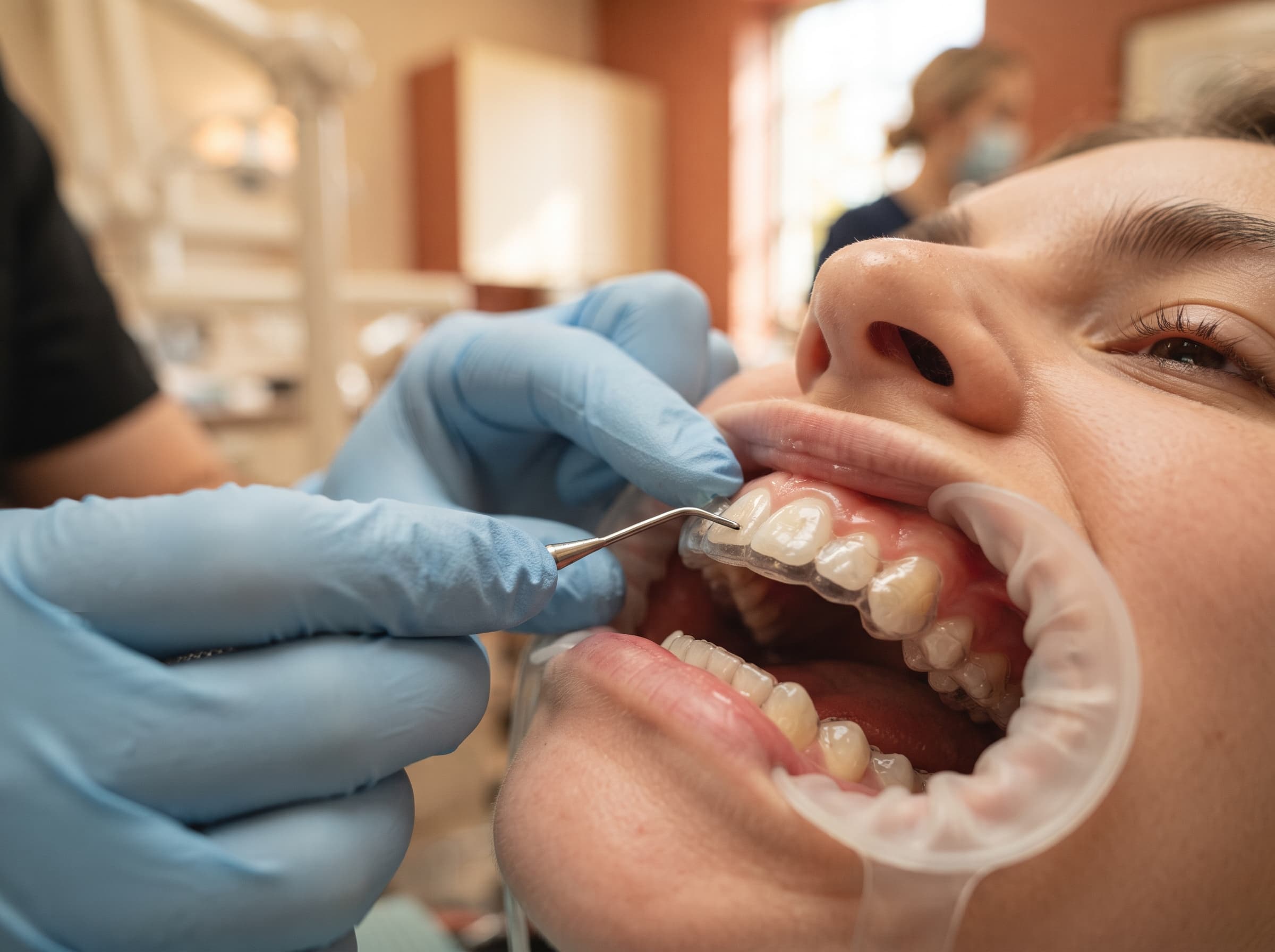 Tratamiento de ortodoncia sobre los dientes de un paciente
