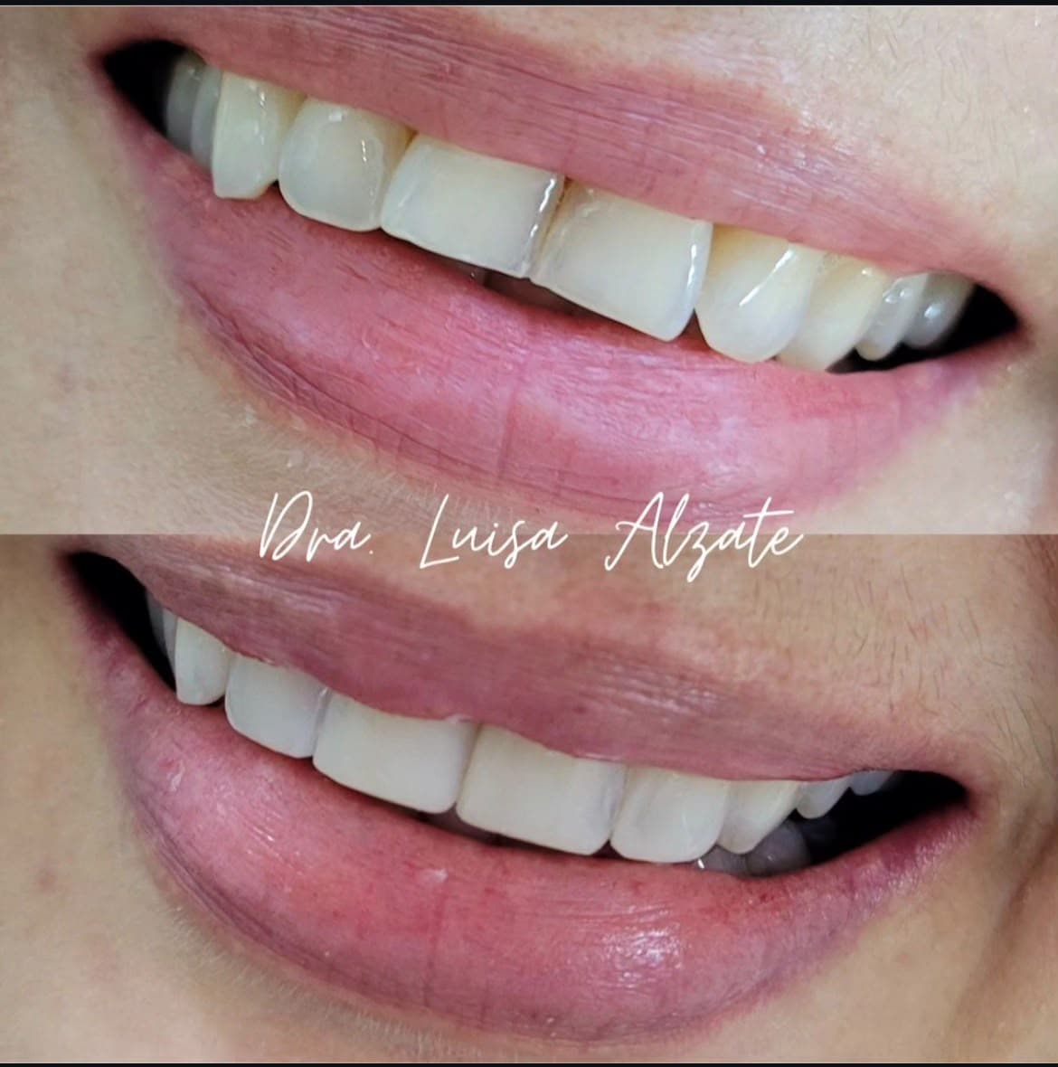 Antes y después de un tratamiento estético dental, sonrisa de perfil