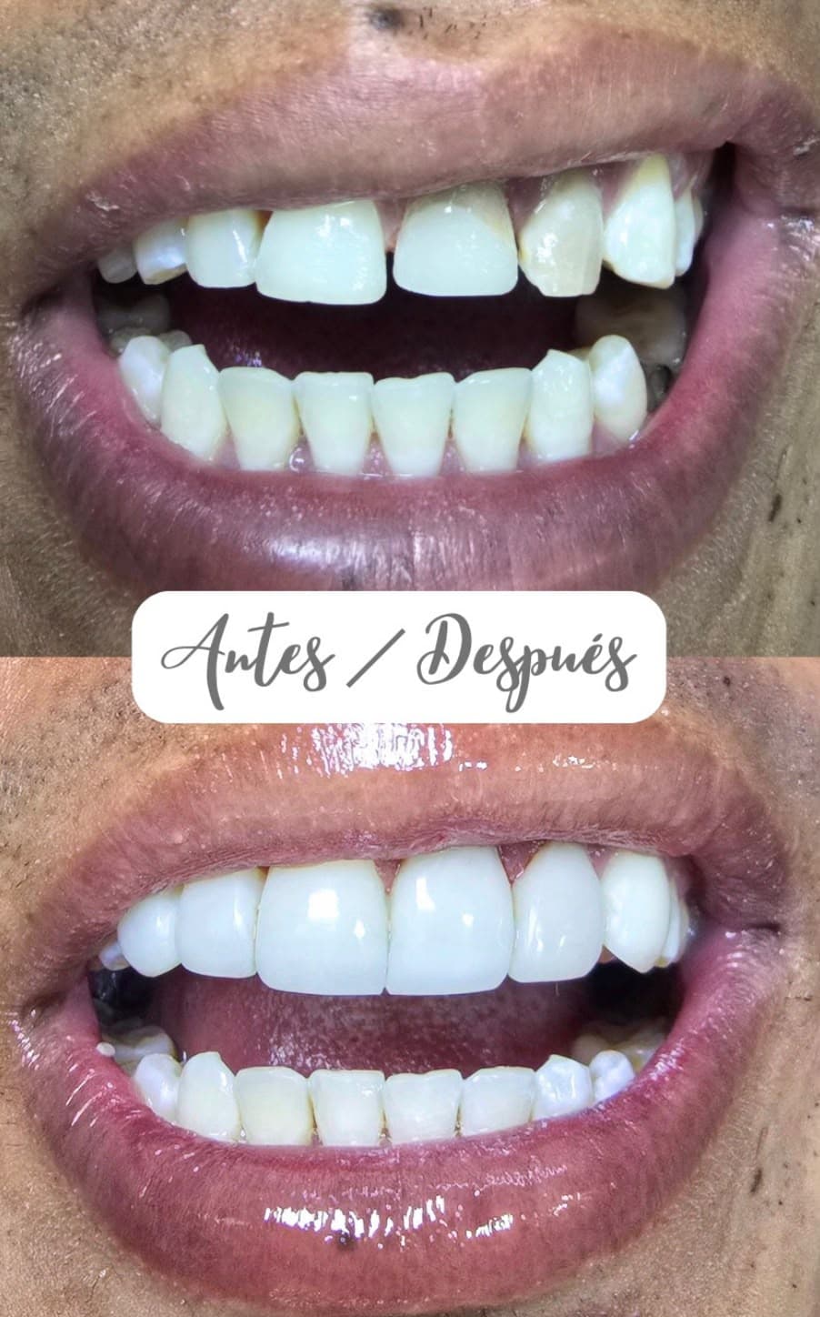 Antes y después de un tratamiento de estética dental en dientes frontales