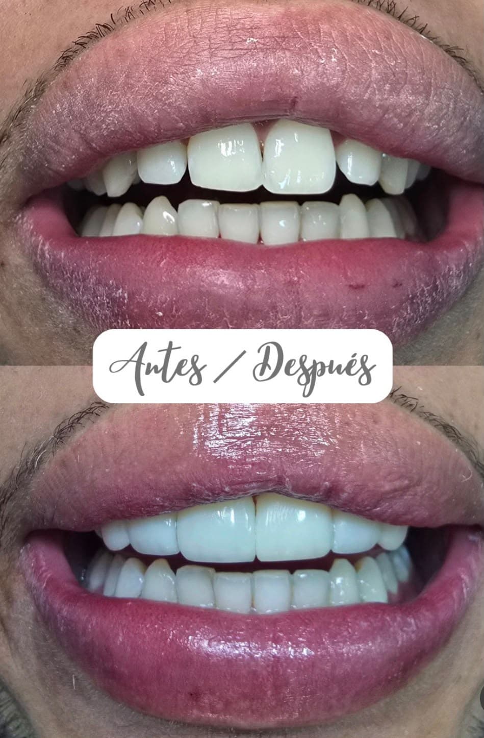 Antes y después de una rehabilitación estética de dientes frontales