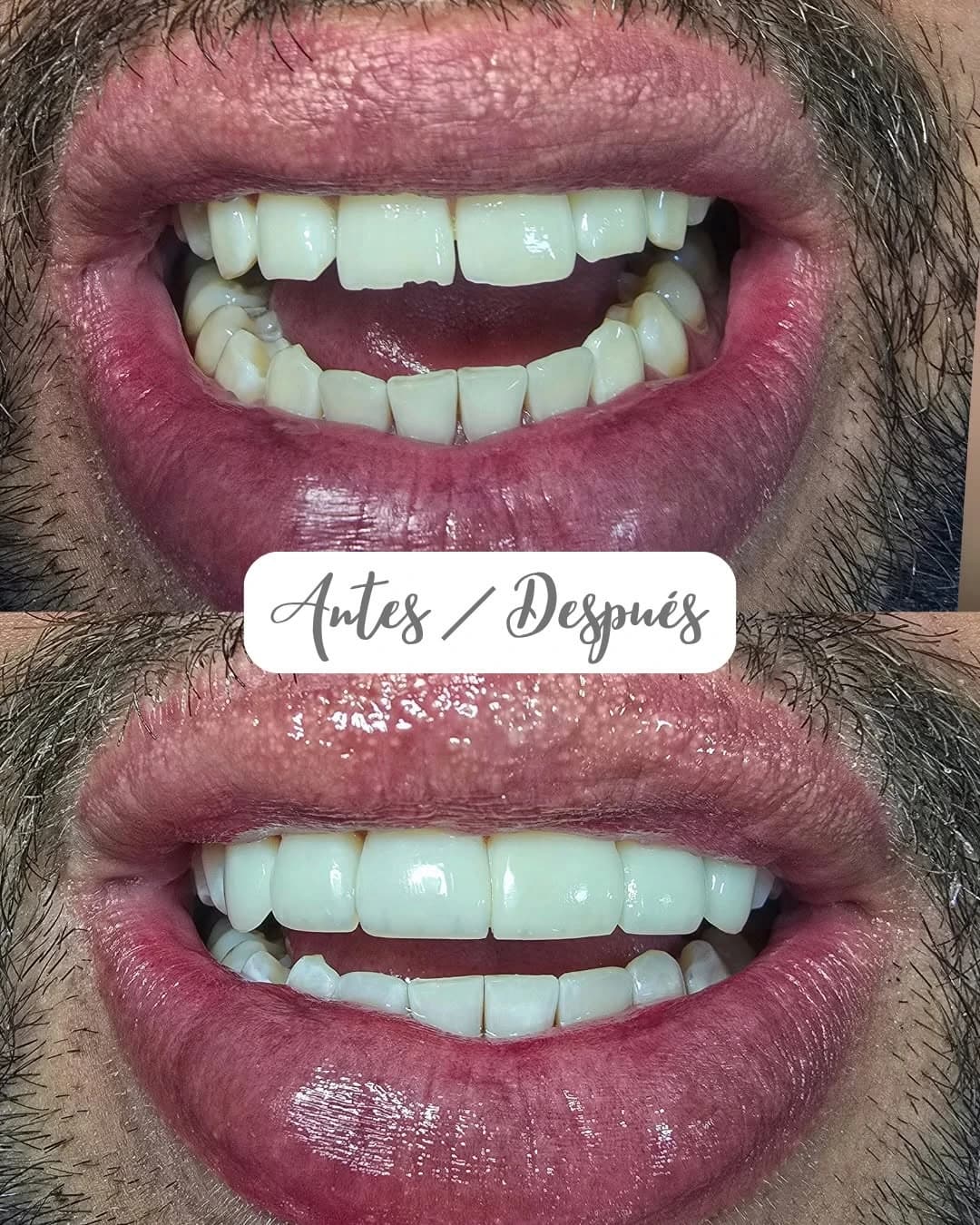 Antes y después de una rehabilitación estética de dientes frontales