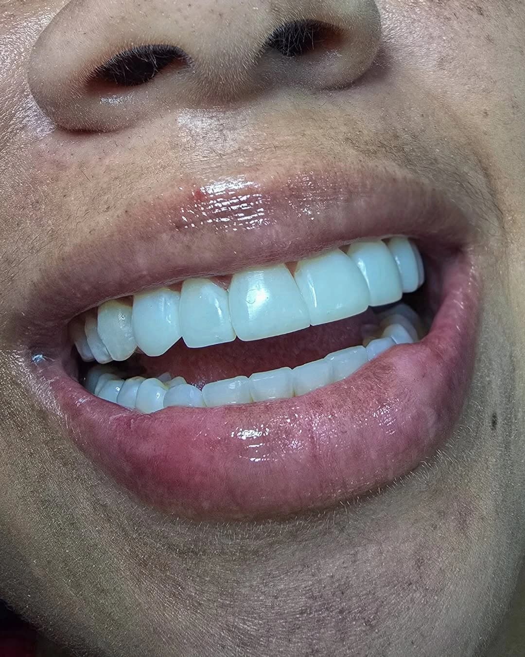 Sonrisa con dientes frontales restaurados con carillas